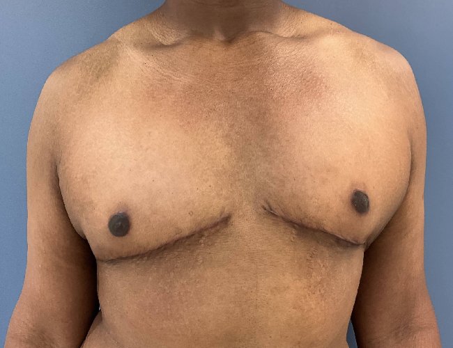 after gynecomastia - mastectomy image front view case 6883