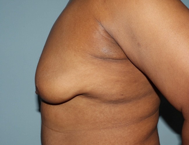 before gynecomastia - mastectomy image left angle case 6883