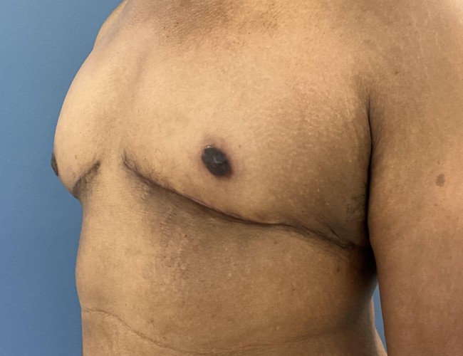 after gynecomastia - mastectomy image 45 degrees left angle case 6883