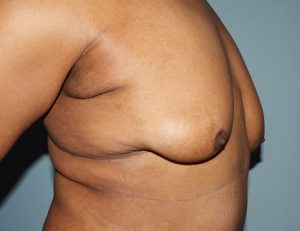 before gynecomastia - mastectomy image right angle case 6883