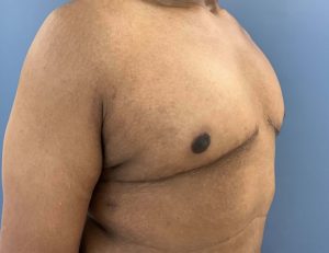 after gynecomastia - mastectomy image right angle case 6883