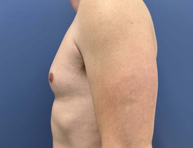 before gynecomastia - male chest contouring left angle case 6893