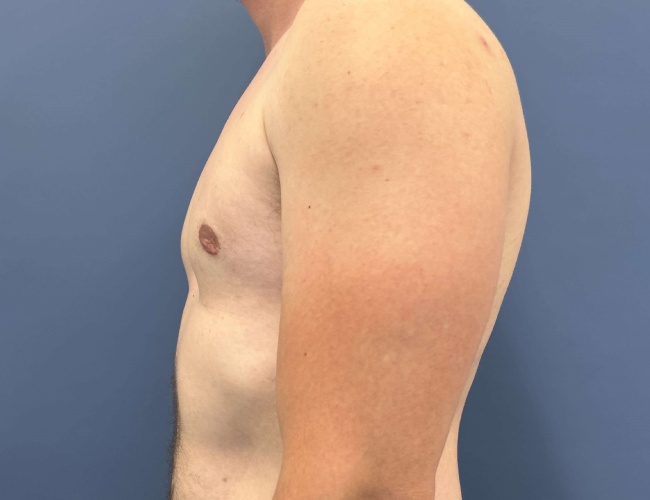 after gynecomastia - male chest contouring left angle case 6893