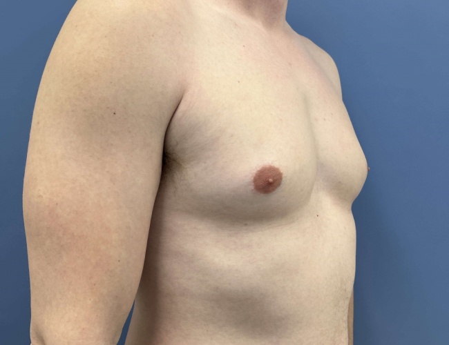 before gynecomastia - male chest contouring 45 degrees right angle case 6893