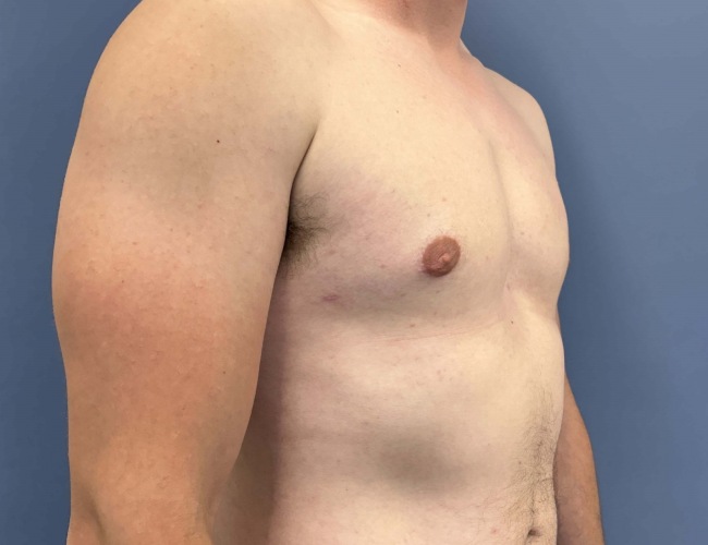 after gynecomastia - male chest contouring right angle case 6893