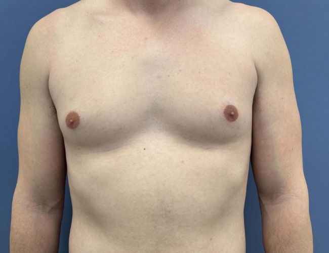 before gynecomastia - male chest contouring front view case 6893