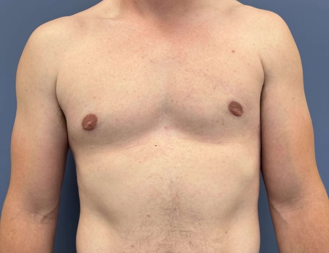after gynecomastia - male chest contouring front view case 6893