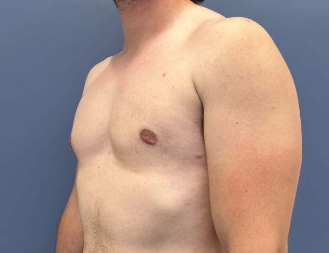 after gynecomastia - male chest contouring 45 degrees left angle case 6893