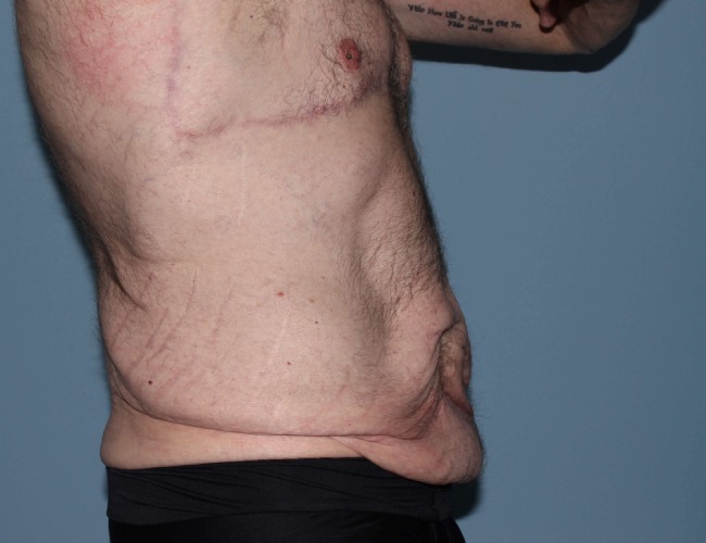 image before gynecomastia - post bariatric right angle case 7174