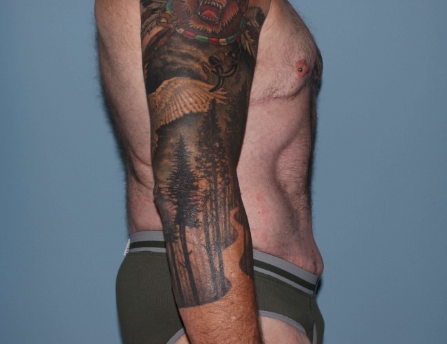 image after gynecomastia - post bariatric right angle case 7174