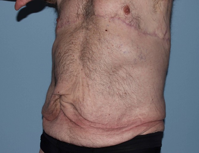 image before gynecomastia - post bariatric 45 degrees left angle case 7174