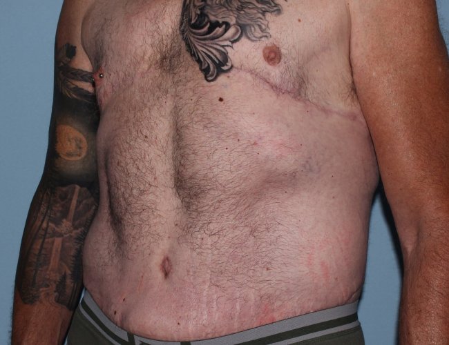 image after gynecomastia - post bariatric 45 degrees left angle case 7174
