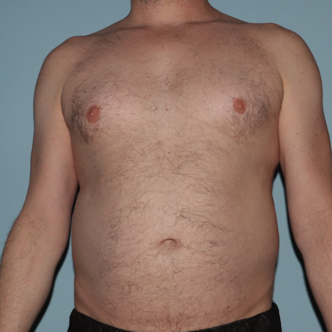 Before Image of Liposuction With BBL- Men Front Side View Case 6921