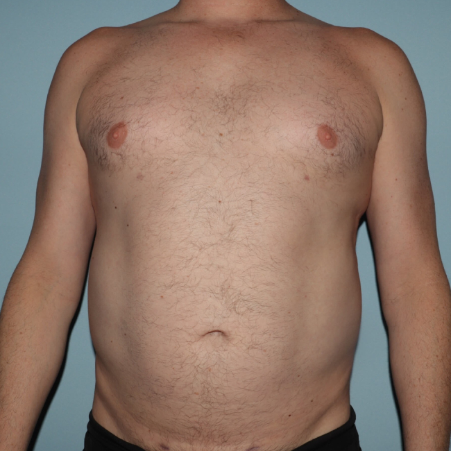 After Image of Liposuction With BBL- Men Front Side View Case 6921