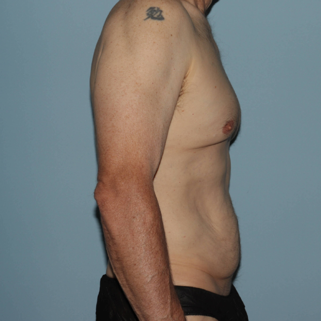 Before Image of Liposuction with Mini -Abdominoplasty - Men Right Side View Case 6937