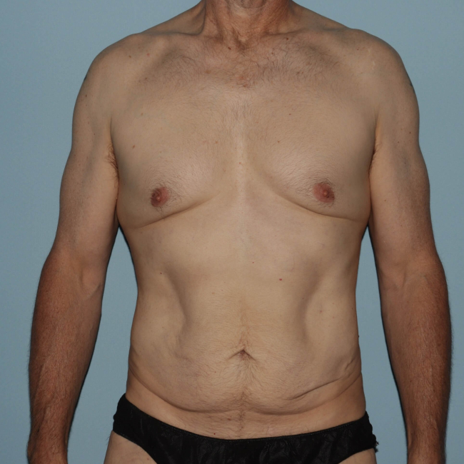 Before Image of Liposuction with Mini -Abdominoplasty - Men Front Side View Case 6937