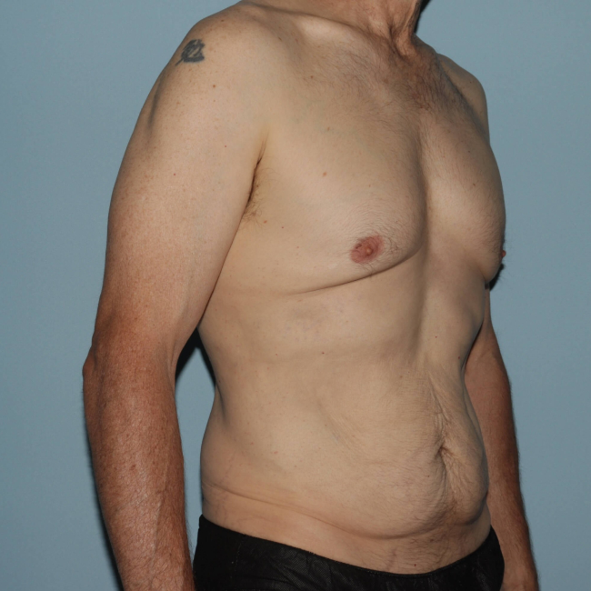 Before Image of Liposuction with Mini -Abdominoplasty - Men Right Side 45 Degree View Case 6937