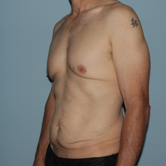 Before Image of Liposuction with Mini -Abdominoplasty - Men Left Side 45 degree View Case 6937