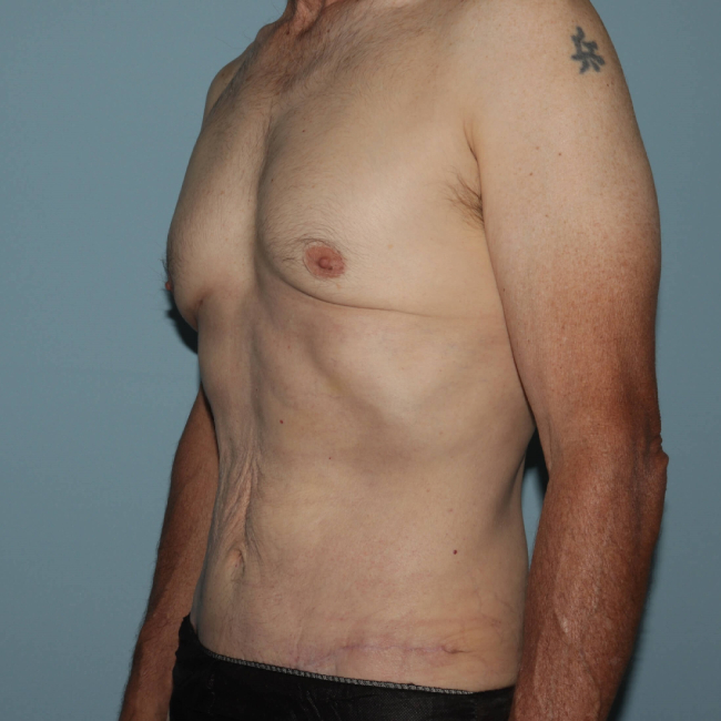 After Image of Liposuction with Mini -Abdominoplasty - Men Left Side 45 Degree View Case 6937