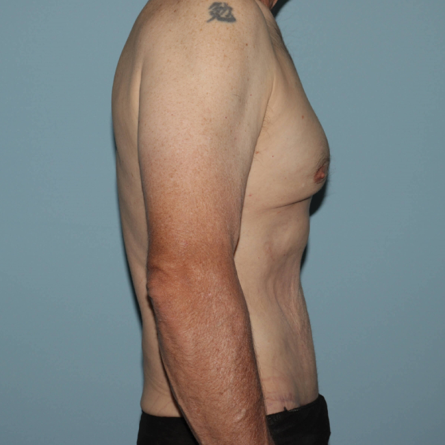After Image of Liposuction with Mini -Abdominoplasty - Men Right Side View Case 6937