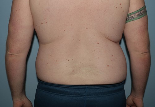 Before Image of Liposuction for Love Handles - Men Back Side View Case 6967