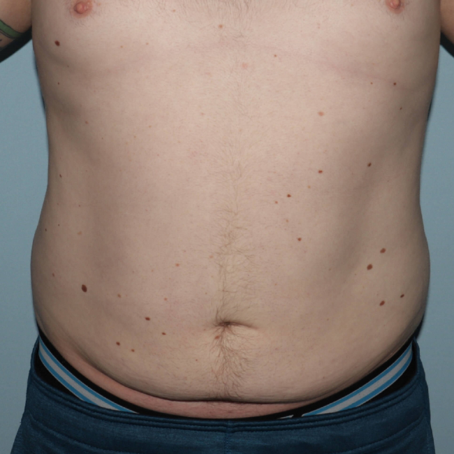 Before Image of Liposuction for Love Handles - Men Front Side View Case 6967