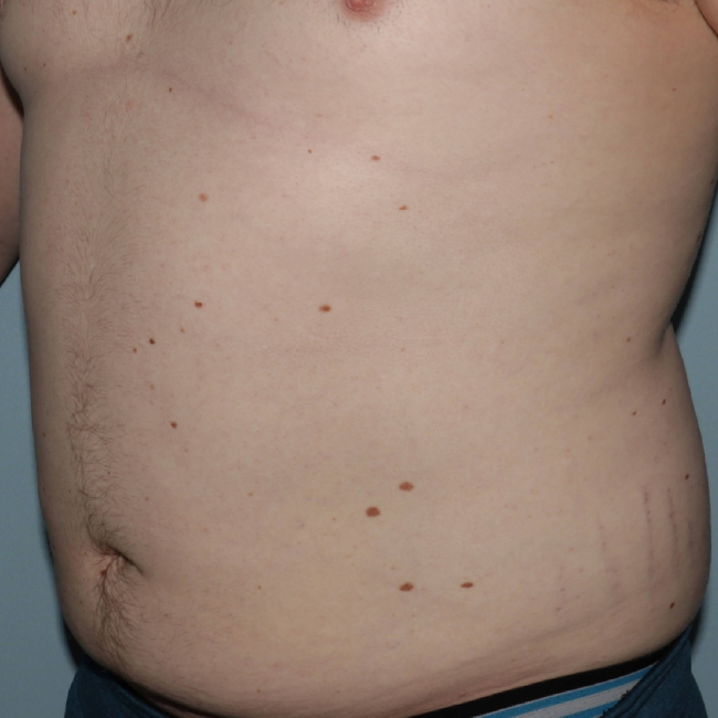 Before Image of Liposuction for Love Handles - Men Left Side 45 degree View Case 6967
