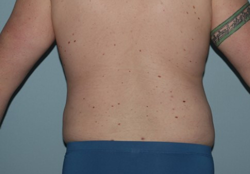 After Image of Liposuction for Love Handles - Men Back Side View Case 6967