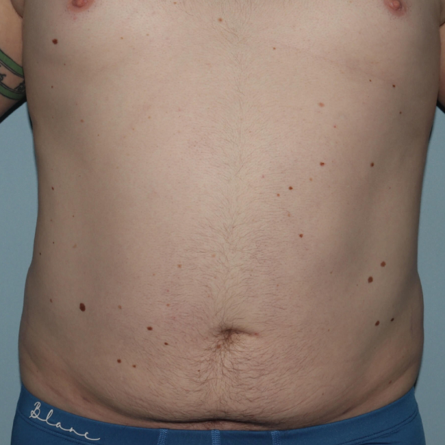 After Image of Liposuction for Love Handles - Men Front Side 45 View Case 6967