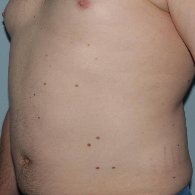 After Image of Liposuction for Love Handles - Men Left Side 45 degree View Case 6967