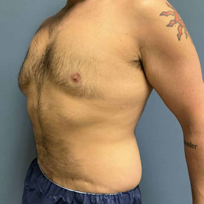 Before Image of Liposuction Vaser and Renuvion Combination - Men Left Side 45 degree View Case 6980