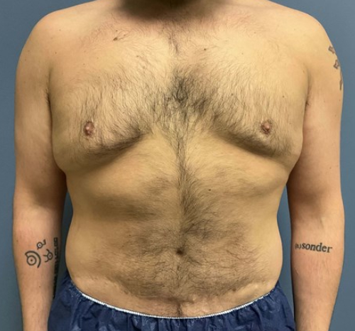 Before Image of Liposuction Vaser and Renuvion Combination - Men Front Side View Case 6980
