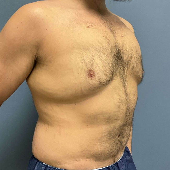 Before Image of Liposuction Vaser and Renuvion Combination - Men Right Side 45 degree View Case 6980