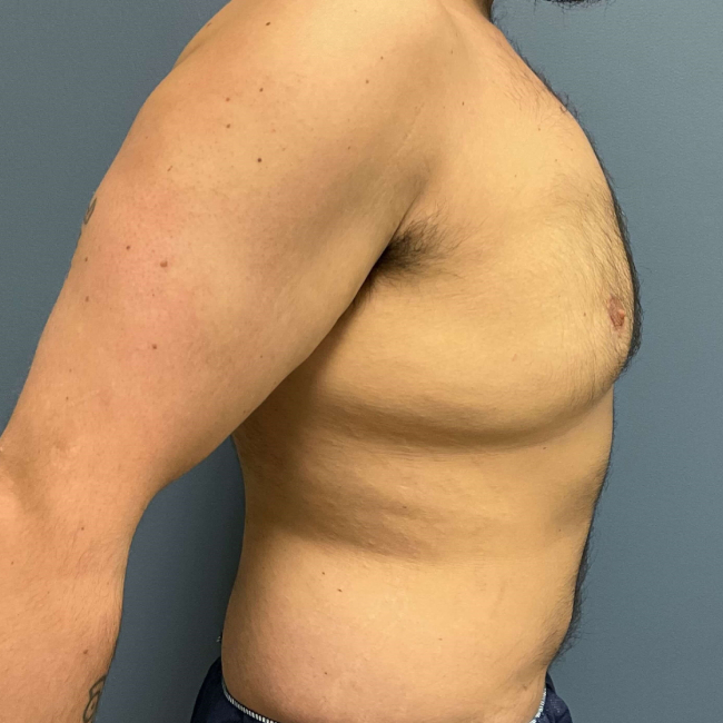 Before Image of Liposuction Vaser and Renuvion Combination - Men Right Side View Case 6980