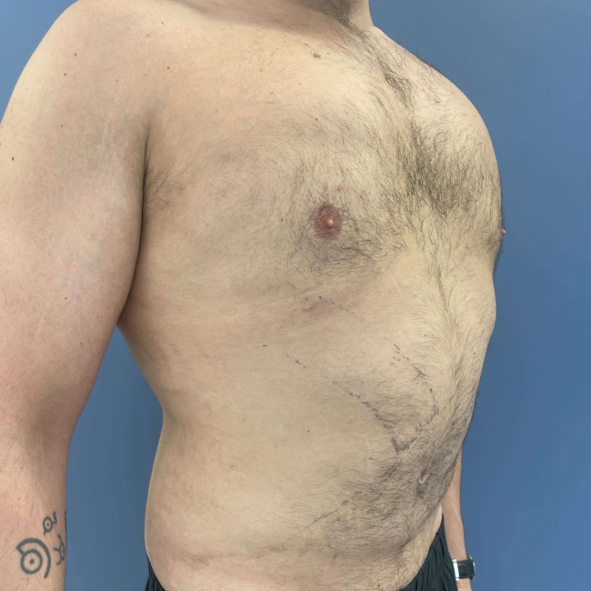 Before Image of Liposuction Vaser and Renuvion Combination - Men Right Side 45 degree View Case 6980