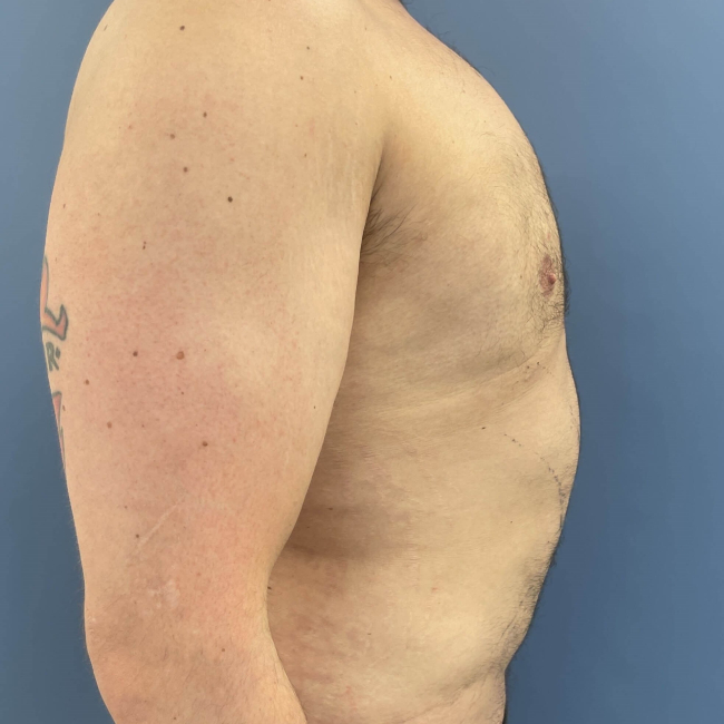 Before Image of Liposuction Vaser and Renuvion Combination - Men Right Side View Case 6980