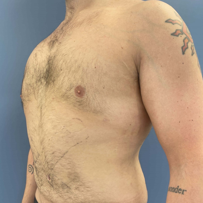 Before Image of Liposuction Vaser and Renuvion Combination - Men Left Side 45 degree View Case 6980