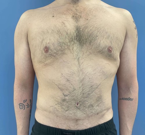 After Image of Liposuction Vaser and Renuvion Combination - Men Front Side View Case 6980