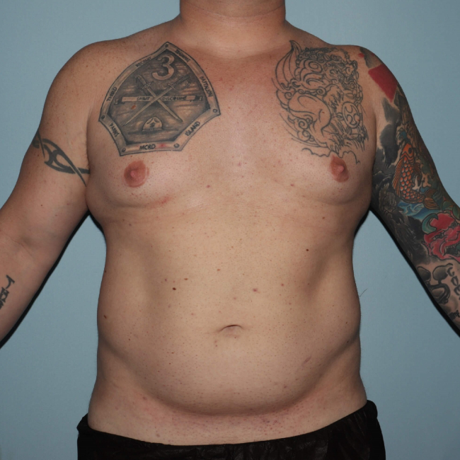 Before Image of Liposuction - Men Front Side View Case 6974