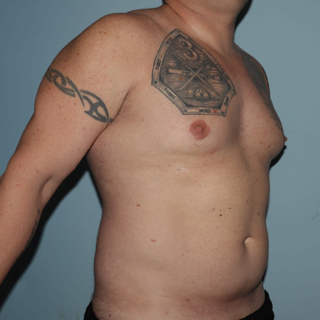 Before Image of Liposuction - Men Right Side 45 degree View Case 6974