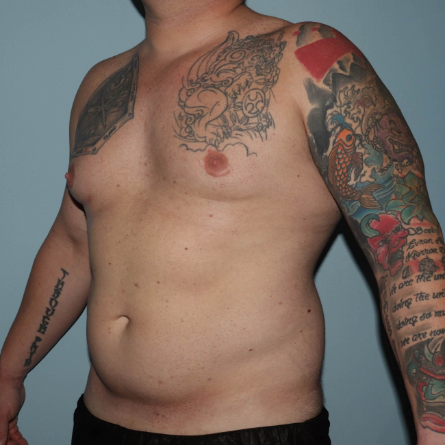 Before Image of Liposuction - Men Left Side 45 degree View Case 6974