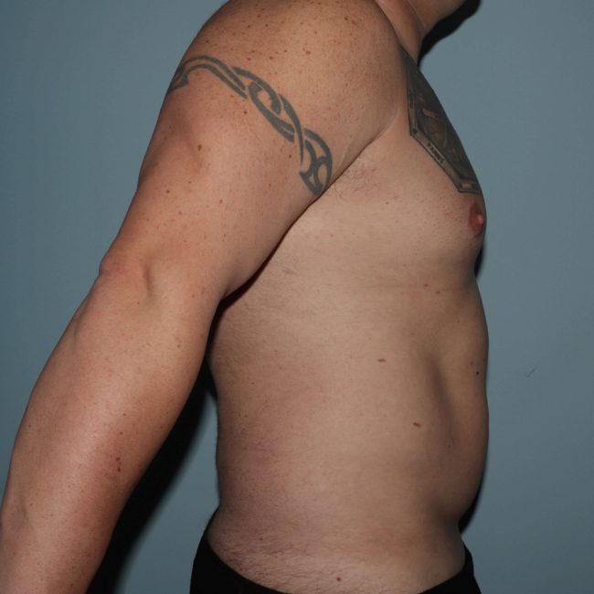 Before Image of Liposuction - Men Right Side View Case 6974