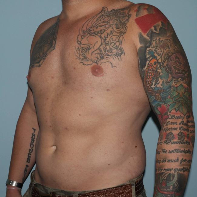 After Image of Liposuction - Men Left Side 45 degree View Case 6974