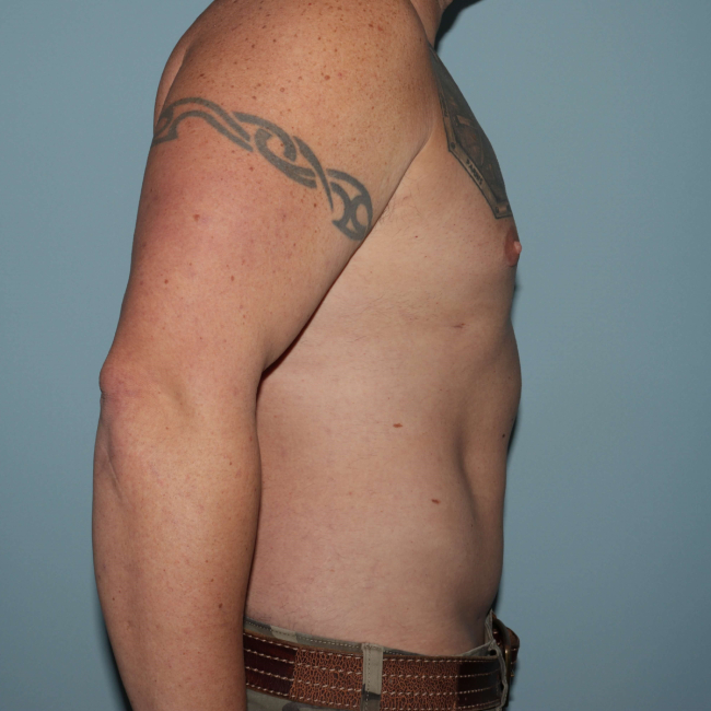After Image of Liposuction - Men Right Side View Case 6974