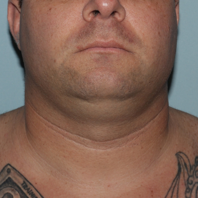 Before Image of Submental Liposuction Improves Jawline Men Front Side View Case 6960