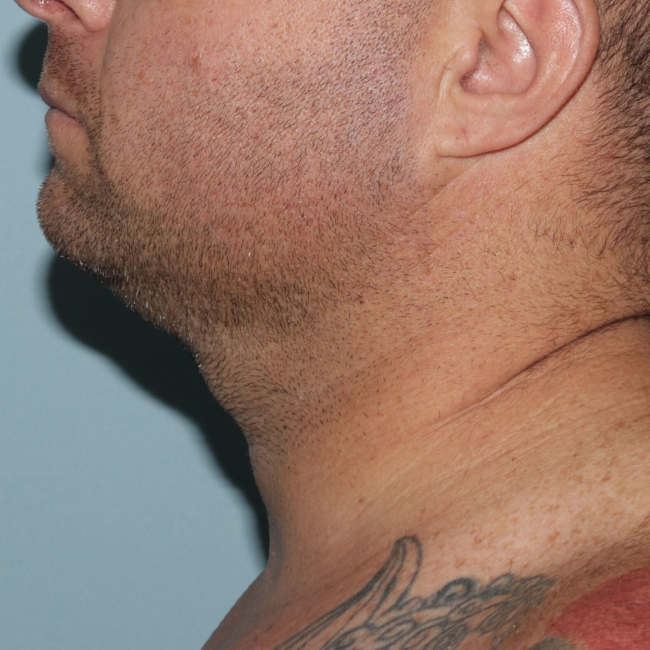 After Image of Submental Liposuction Improves Jawline Men Left Side View Case 6960