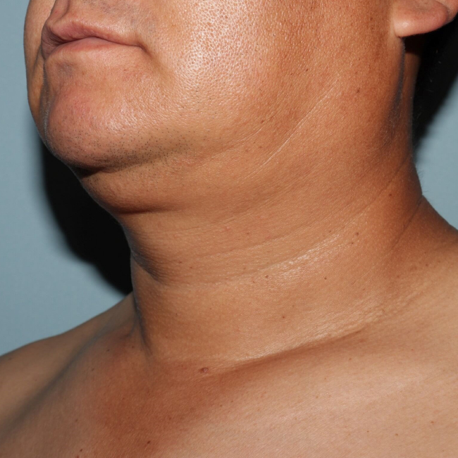 Before Image of Liposuction Improve Double Chin- Men Left Side 45 degree View Case 6975