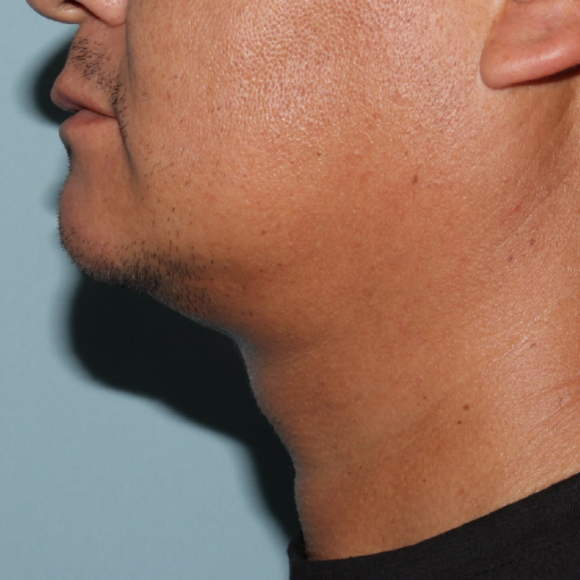 After Image of Liposuction Improve Double Chin- Men Left Side View Case 6975