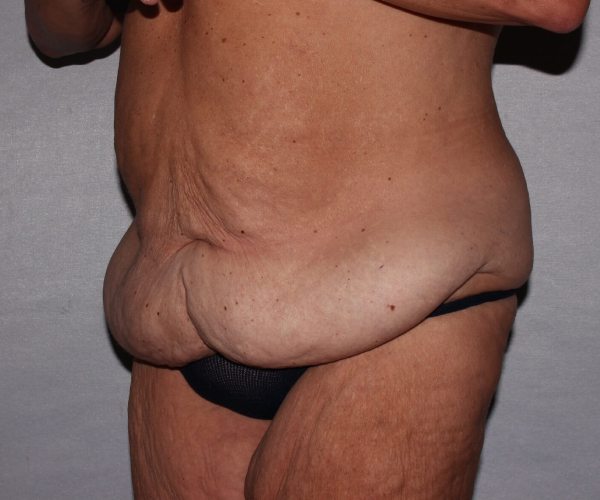 before lower body lift female patient - 45 degrees left angle case 7516