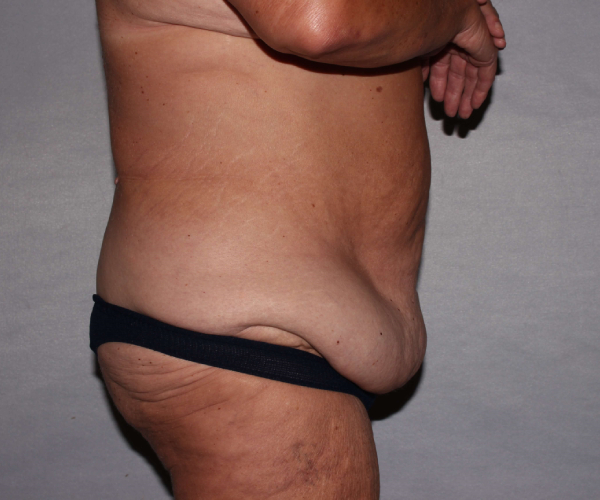 before lower body lift female patient - right angle case 7516